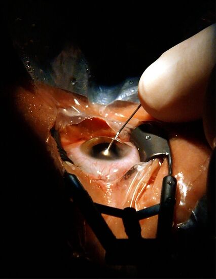A NEW TECHNIQUE OF REPLACING EYE LENS