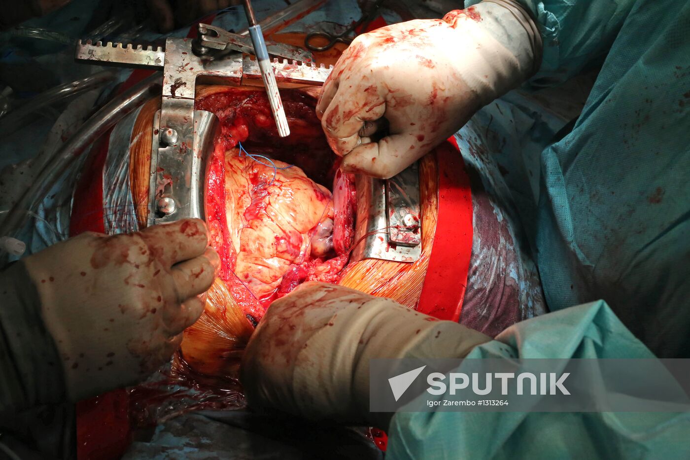 Work of Kaliningrad Center of Cardiovascular Surgery
