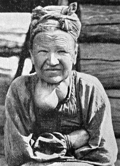 WOMAN GOITER DISEASE