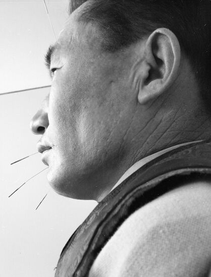 ACUPUNCTURE THERAPY