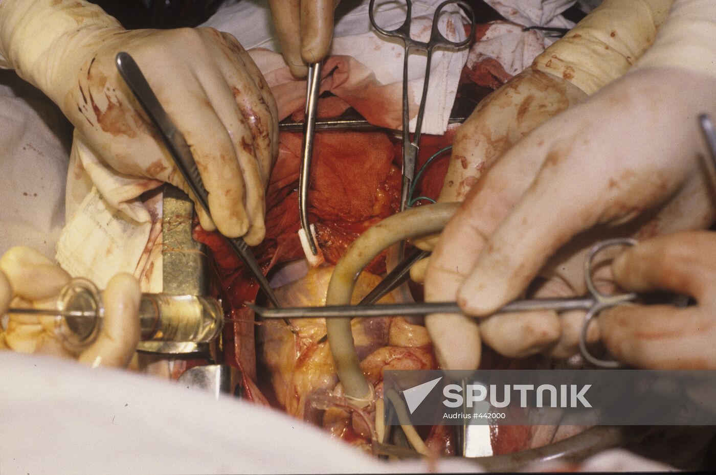 Heart surgery