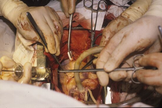 Heart surgery