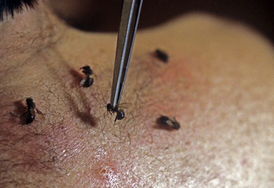 Bee sting treatment session