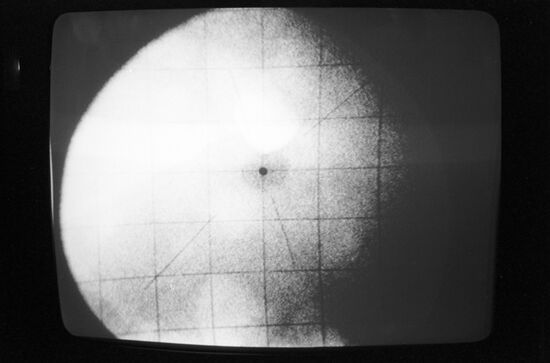 Image of human kidney stone