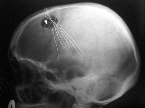 Brain with implant