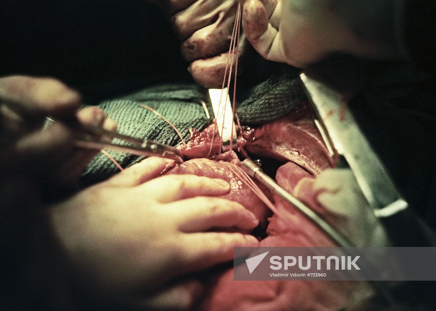 Cardiac surgery