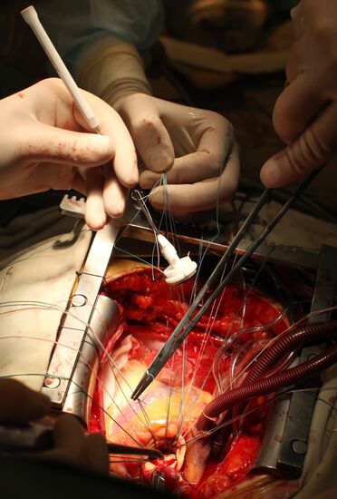 Valve replacement operation