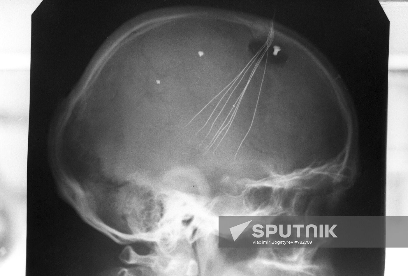 X-ray picture of skull