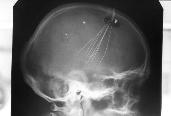 X-ray picture of skull