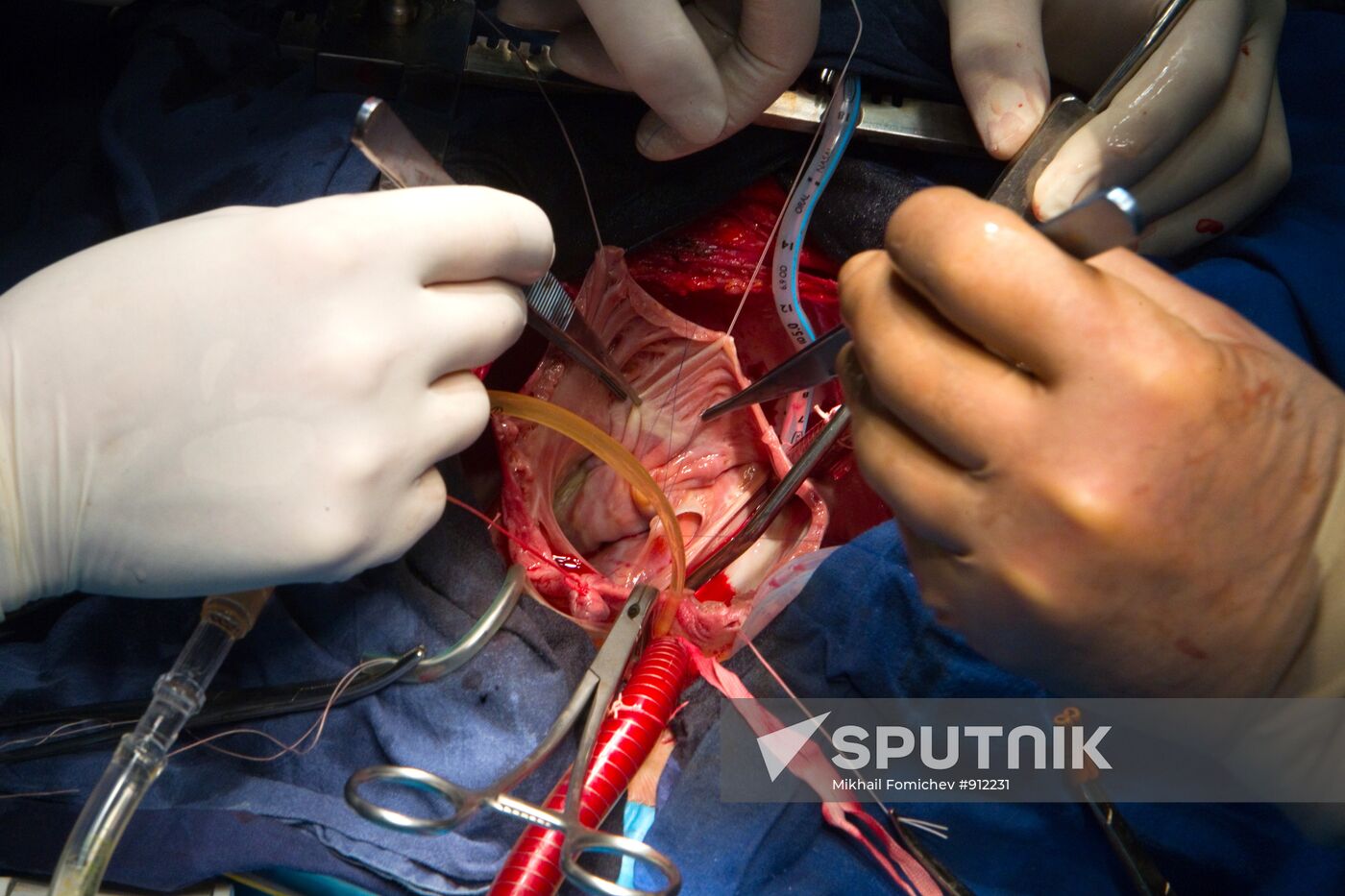Heart valve replacement surgery