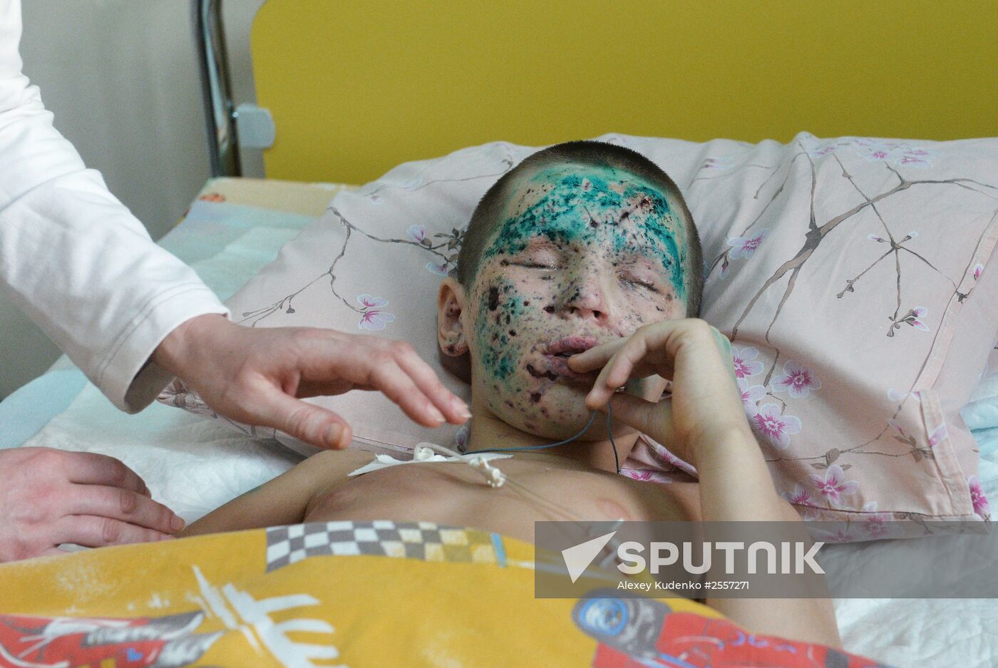 Wounded children from Donetsk treated in Moscow