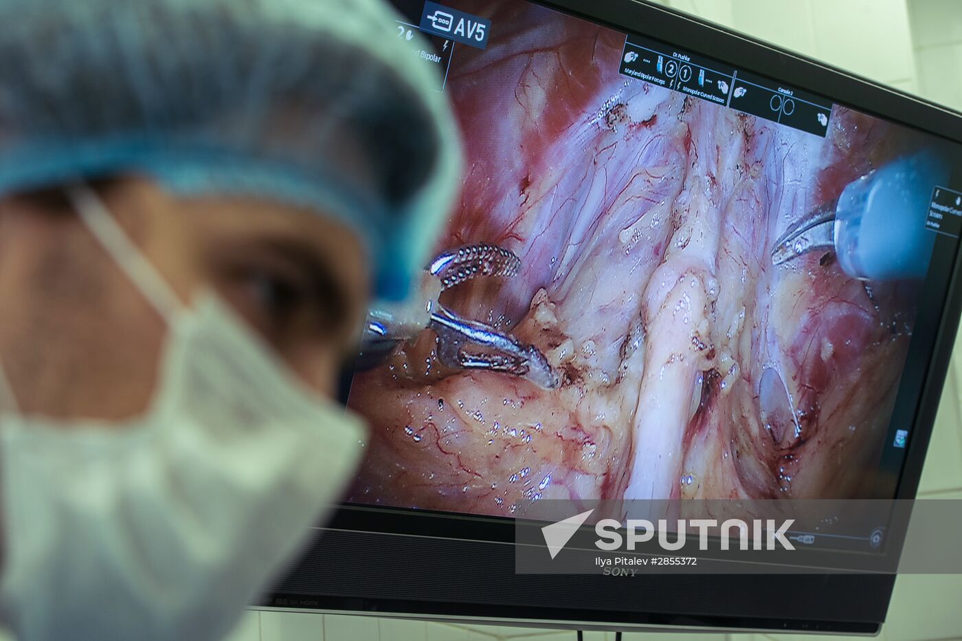 Oncology surgery using da Vinci Surgical System