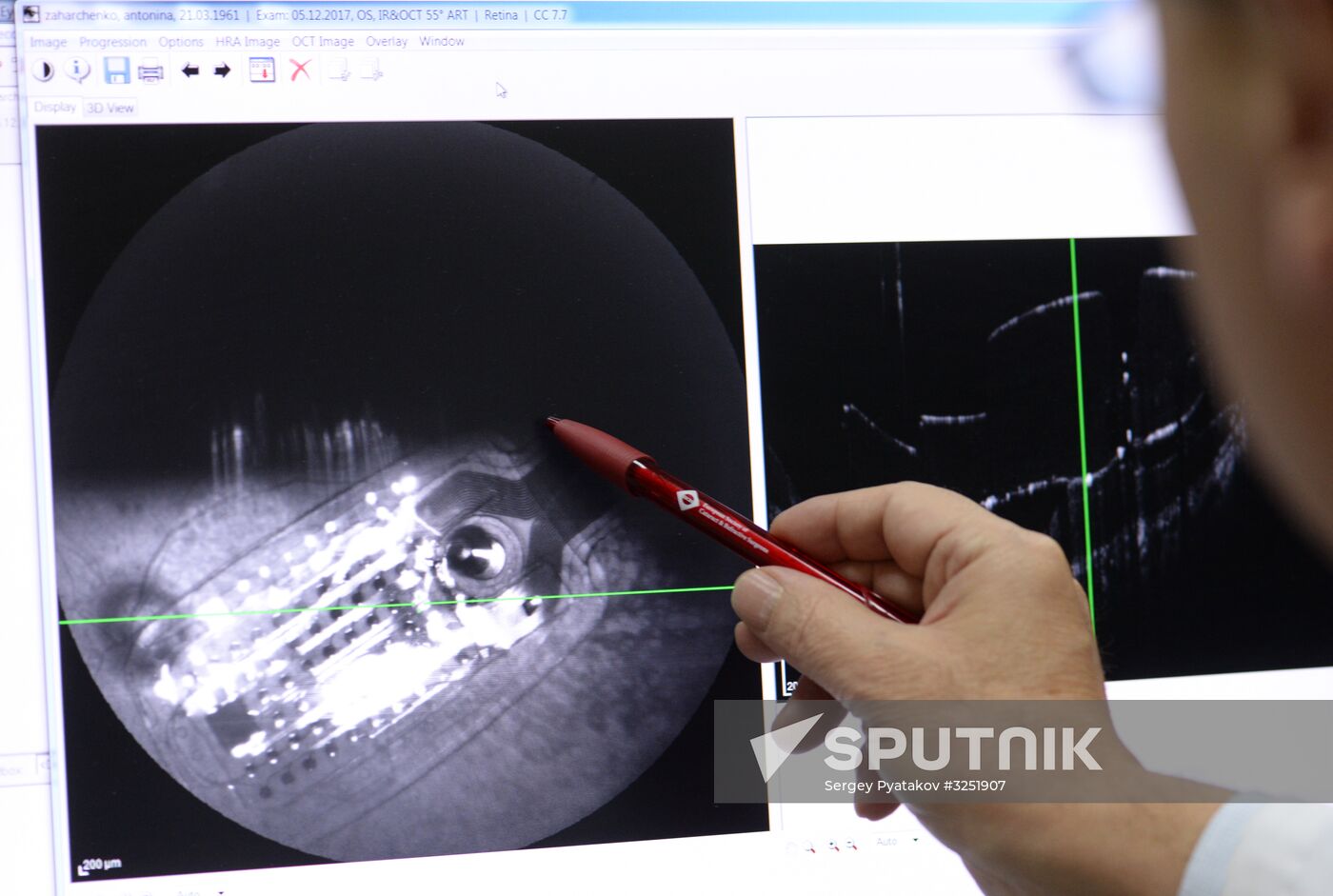 Bionic eye implanted to patient at Russian Otolaryngology research clinic