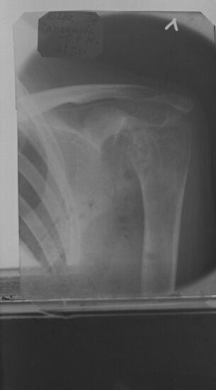 Osteoarticular tuberculosis