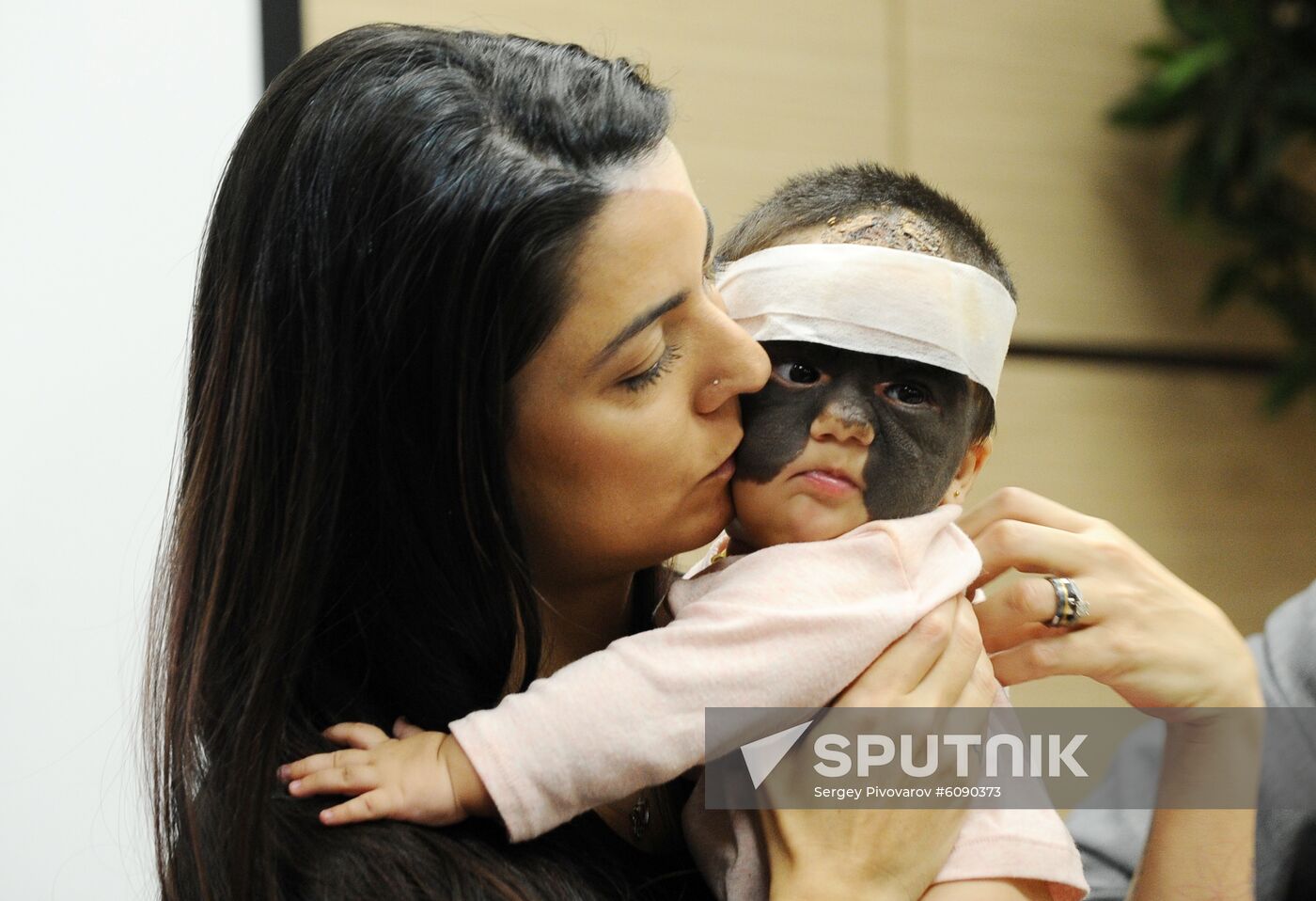 Russia US 'Batman Mask' Birthmark Luna Fenner