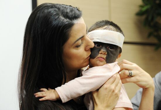 Russia US 'Batman Mask' Birthmark Luna Fenner