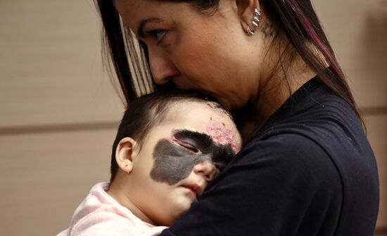 Russia US 'Batman Mask' Birthmark Luna Fenner