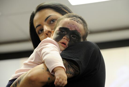 Russia US 'Batman Mask' Birthmark Luna Fenner