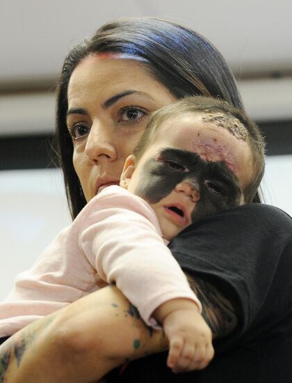 Russia US 'Batman Mask' Birthmark Luna Fenner