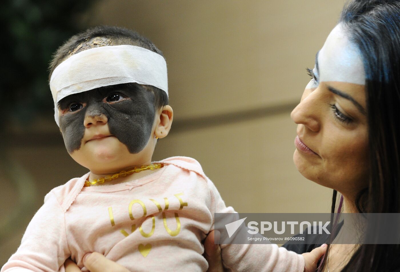 Russia US 'Batman Mask' Birthmark Luna Fenner