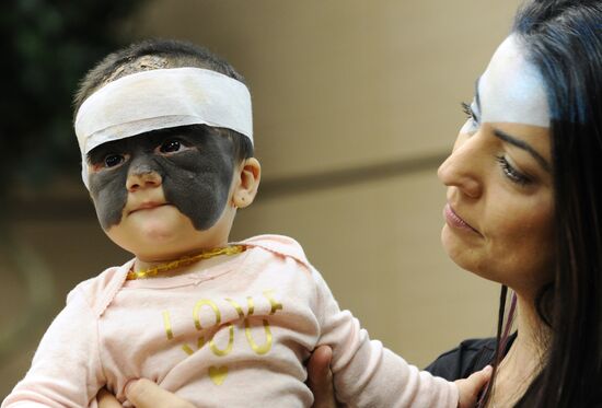 Russia US 'Batman Mask' Birthmark Luna Fenner