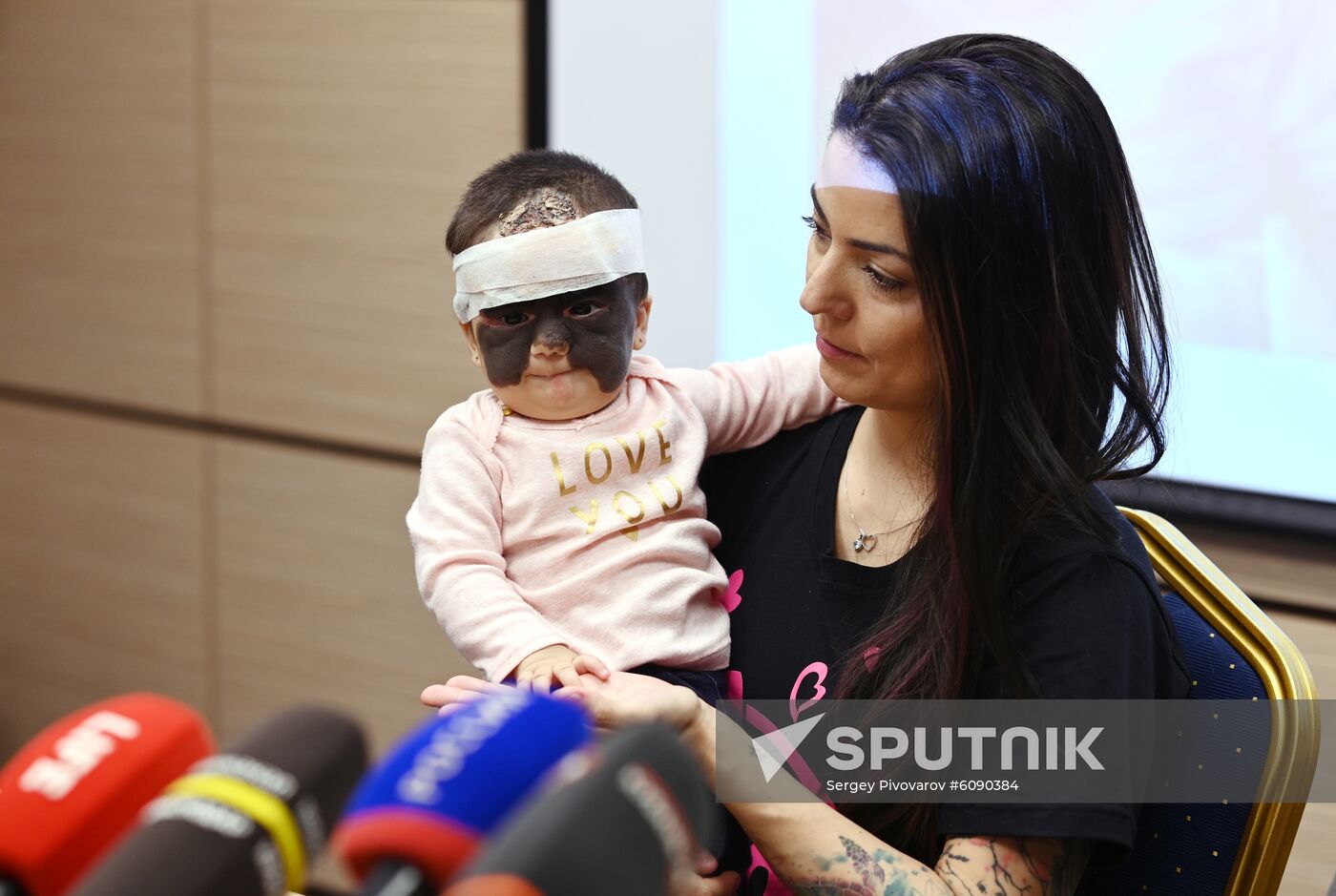 Russia US 'Batman Mask' Birthmark Luna Fenner