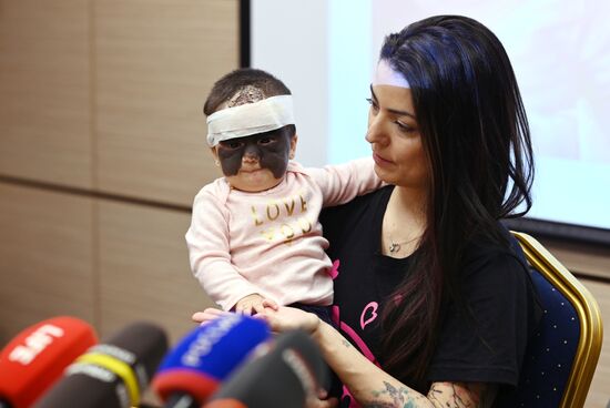 Russia US 'Batman Mask' Birthmark Luna Fenner