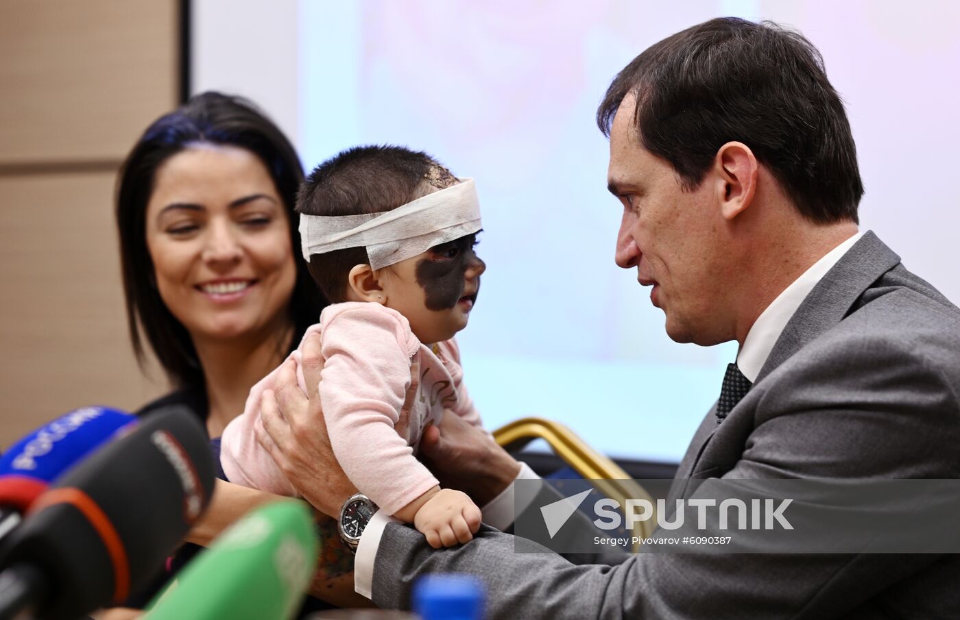 Russia US 'Batman Mask' Birthmark Luna Fenner