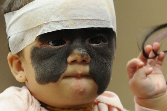Russia US 'Batman Mask' Birthmark Luna Fenner