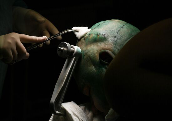 Russia Brain Tumors Surgery