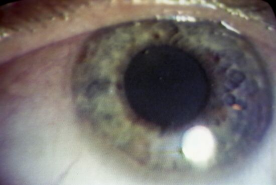 Iris-based diagnostics