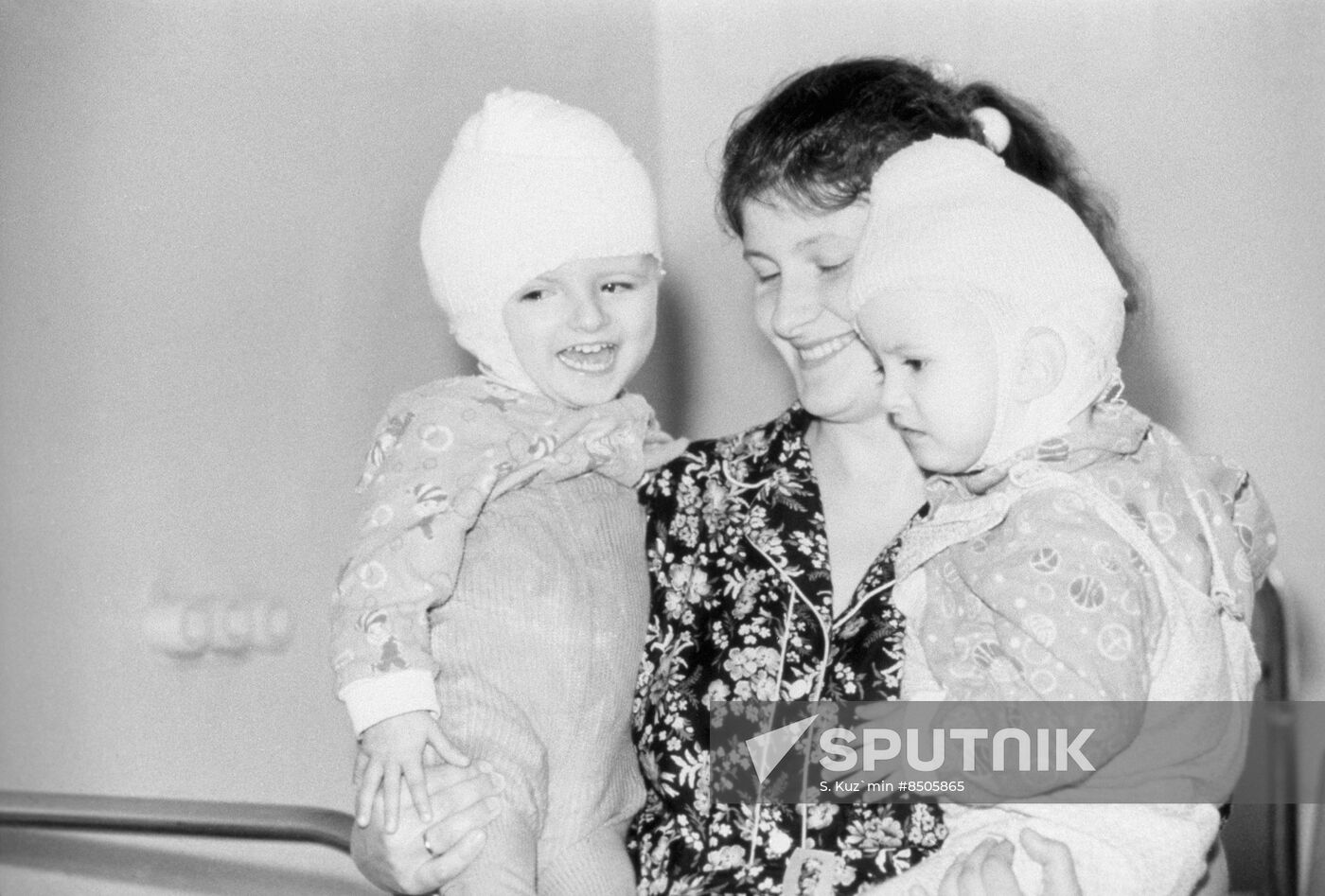 Siamese twins Vilija and Vitalija Tamuleviciute