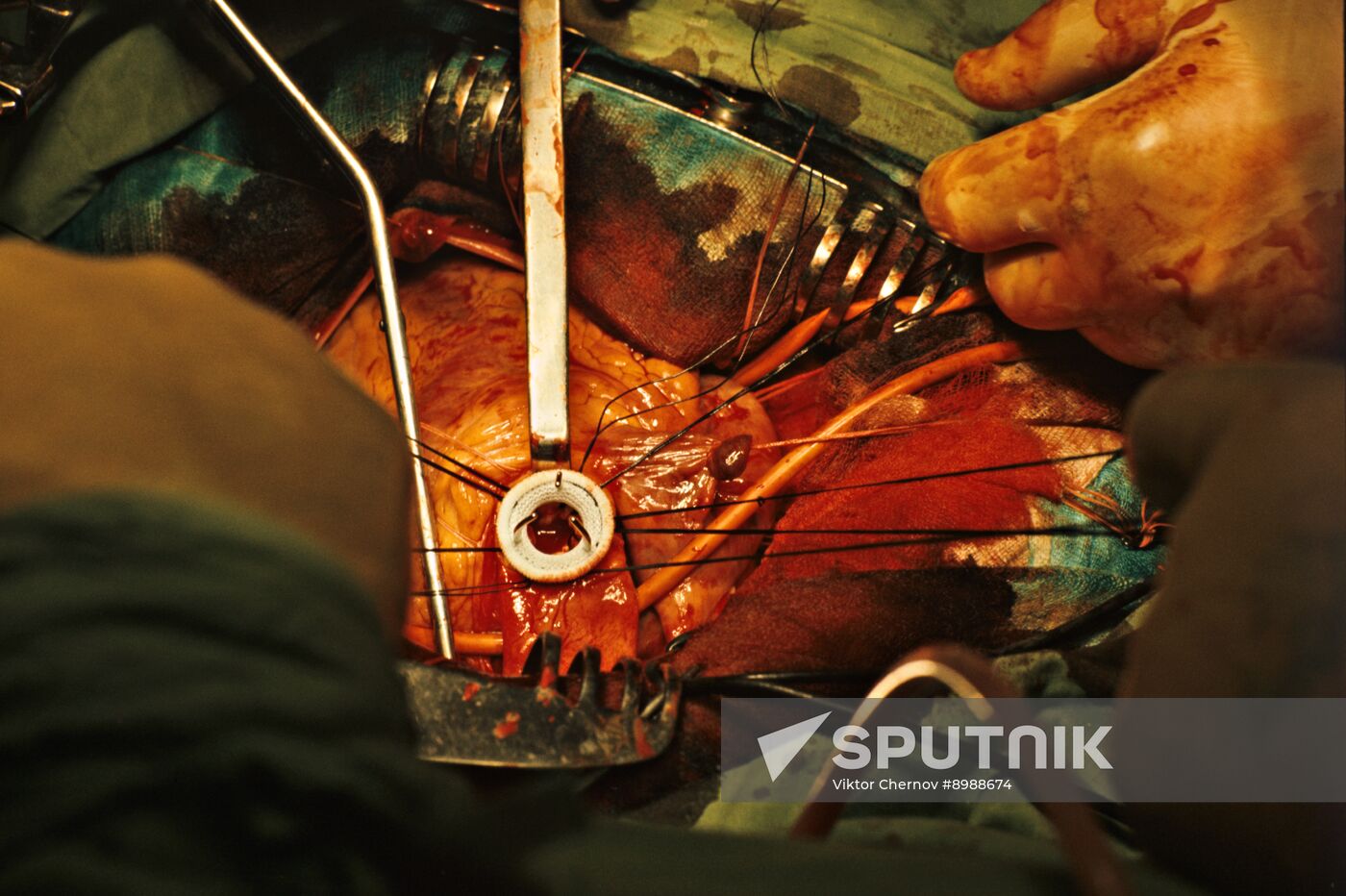 Implanting an artificial heart valve