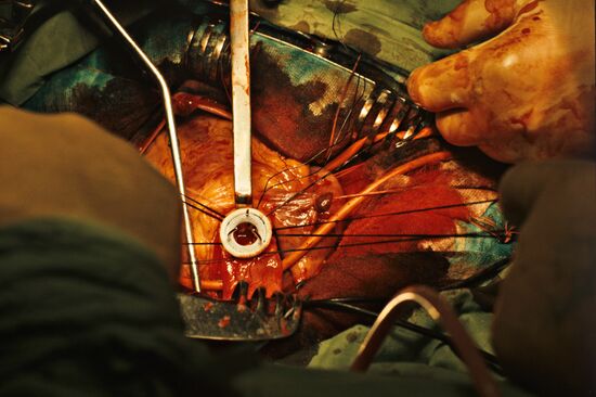 Implanting an artificial heart valve